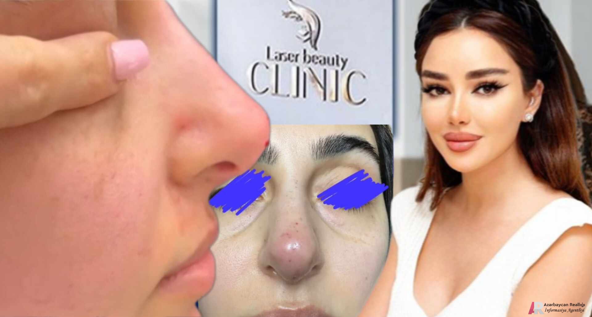 Kosmetoloq Rəna Soltanova vətəndaşın burnun şikəst edib - “Laser Beauty Clinic” QƏSSABXANA kimi işləyir (VİDEO)