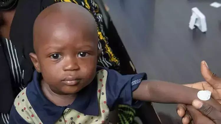 Qambiyada aparılan mikro iynə yamaq peyvəndi sınağının nəticələri uğurlu olub