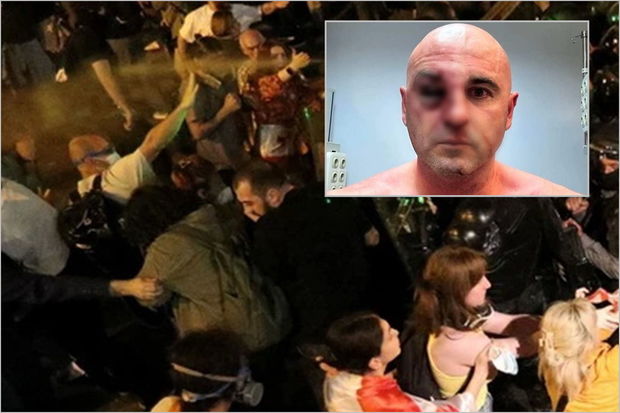 Gürcüstanda etirazlara qoşulan deputat döyüldü - FOTO