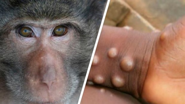 ÜST meymunçiçəyi xəstəliyinə yoluxanların sayını AÇIQLADI