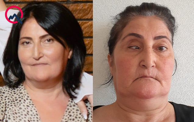 Burun əməliyyatına girən qadının gözündə çəplik yarandı - FOTO