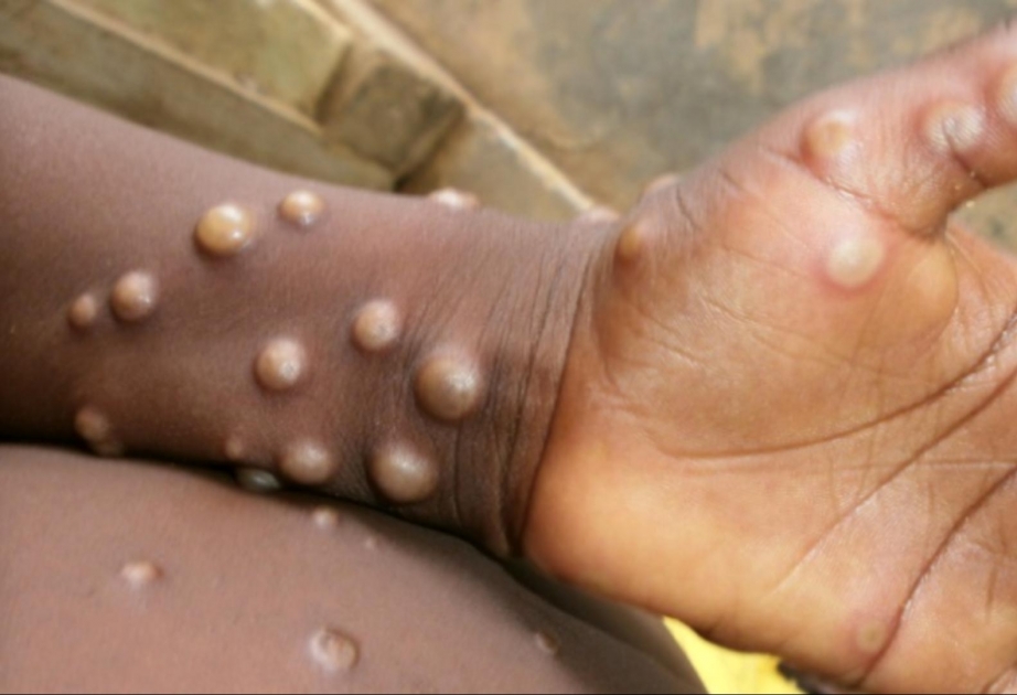 Bu ölkədə meymunçiçəyinə yoluxma səngimək bilmir - 570 nəfər virusdan ölüb