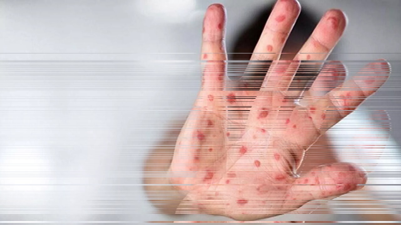 Argentinada yük gəmisi meymun çiçəyi virusu ilə bağlı karantinə alındı