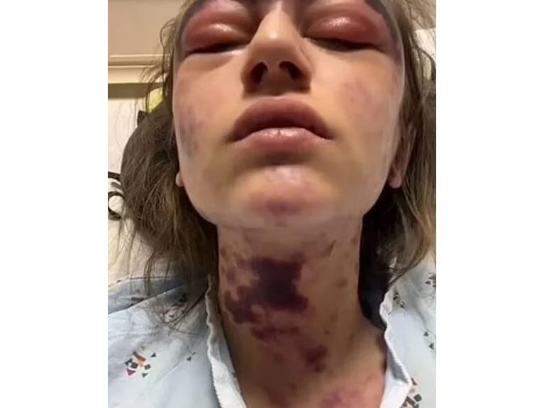 23 yaşlı gənc qadın peyvənd olunduqdan 10 dəqiqə sonra kor olub