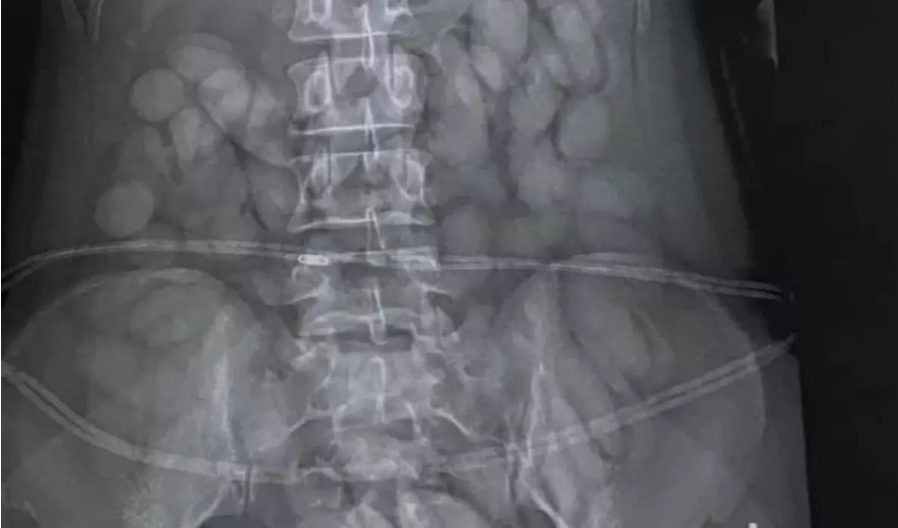 Hava limanında mədəsində narkotik həb keçirmək istəyən qadın həbs edildi