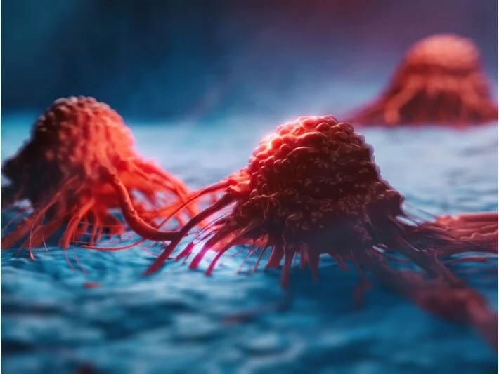 Döş xərçəngi 50 yaşdan aşağı insanlarda artıb: Ölüm nisbəti irqə görə dəyişir! 