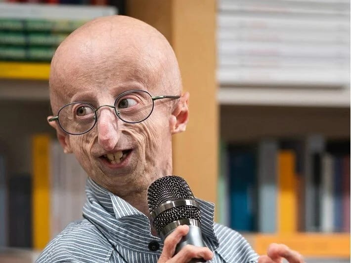 Benjamin Button xəstəliyinin simvolu oldu: 28 yaşında öldü 