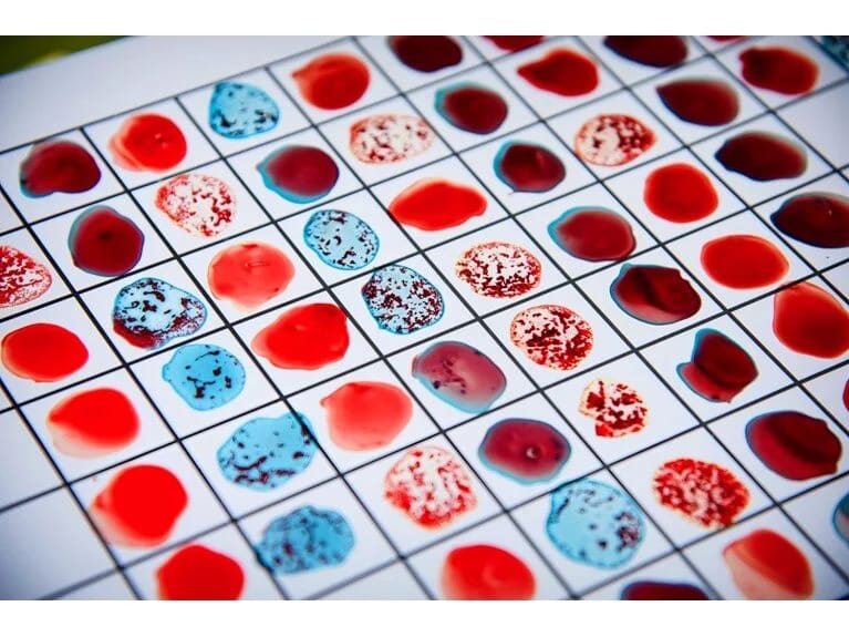 Qan qrupunuz sizi xəbərdar edir! Bu qan qrupuna sahibsinizsə, insult keçirmə riskiniz daha yüksəkdir