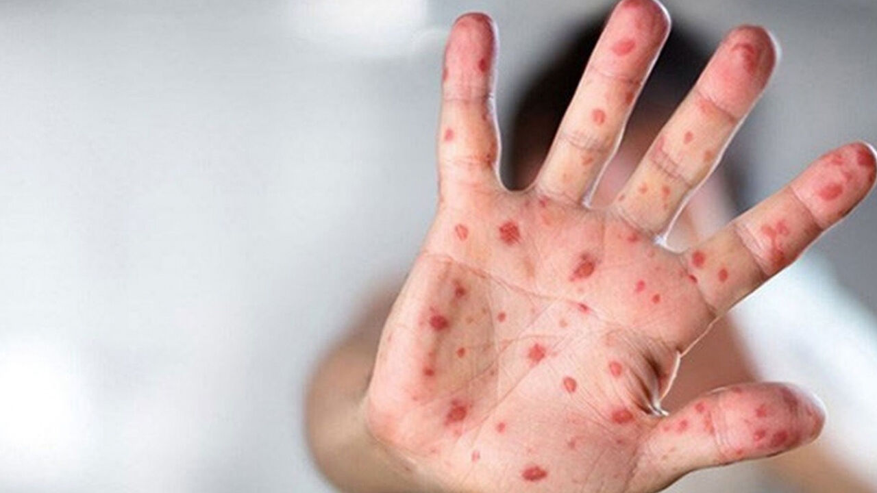 Meymunçiəyi virusu tüğyan edir - Daha iki ölkədə təsbit edildi