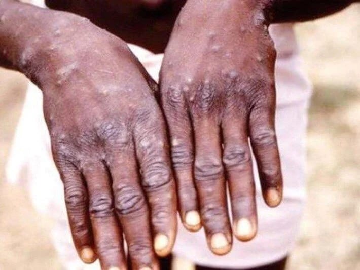 Afrikada meymun çiçəyindən ölənlərin sayı 1100-ə yüksəldi