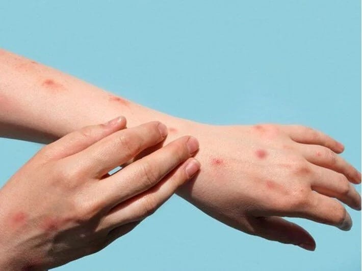 Almaniyada meymunçiçəyi virusunun yeni variantı ortaya çıxıb