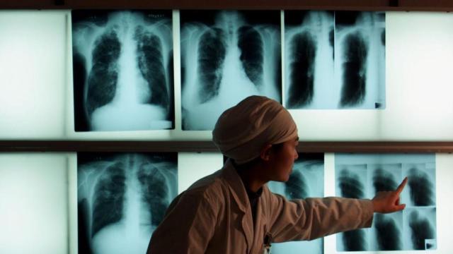 Vərəm yenidən ən ölümcül yoluxucu xəstəlik oldu