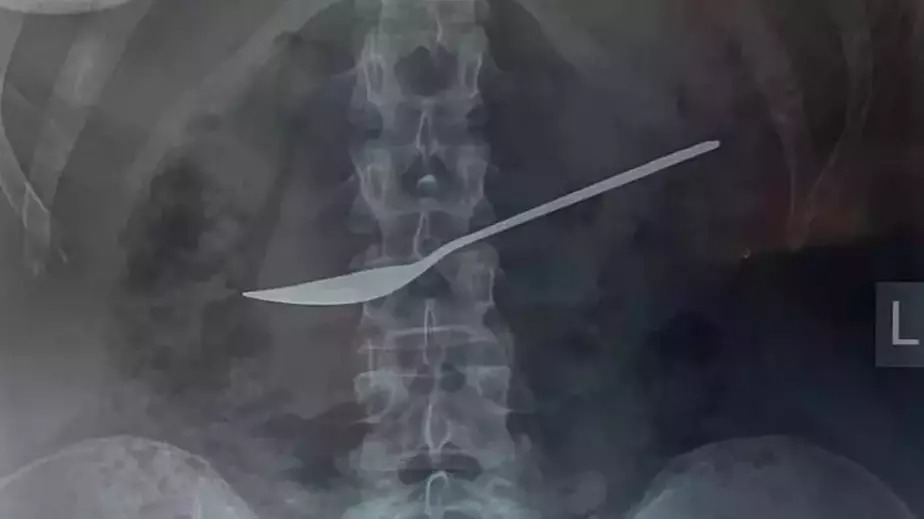 Qarın ağrısı ilə xəstəxanaya aparılan qadının mədəsindən görün nə çıxarıldı