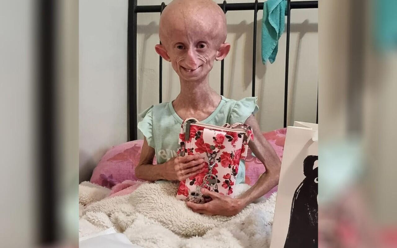 Beandri Buysen öldü - Hər il səkkiz yaş qocalırdı... - FOTO