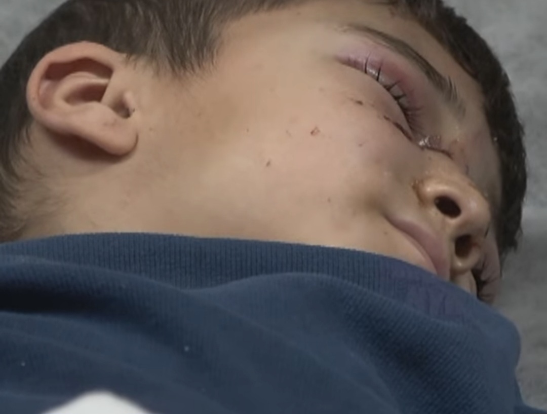 Türkiyədə sahibsiz itlər 7 yaşlı uşağa hücum etdi