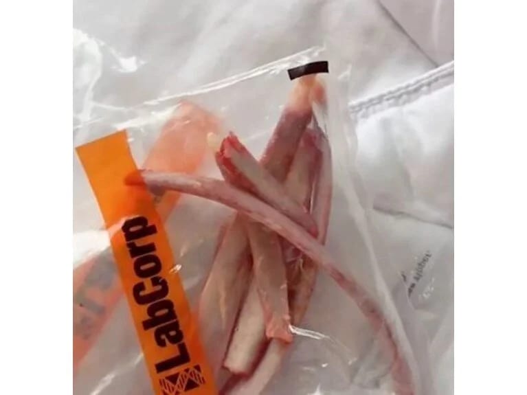 İncəlmək üçün 6 qabırğasını çıxartdı: Onu dostuma hədiyyə edəcəm 