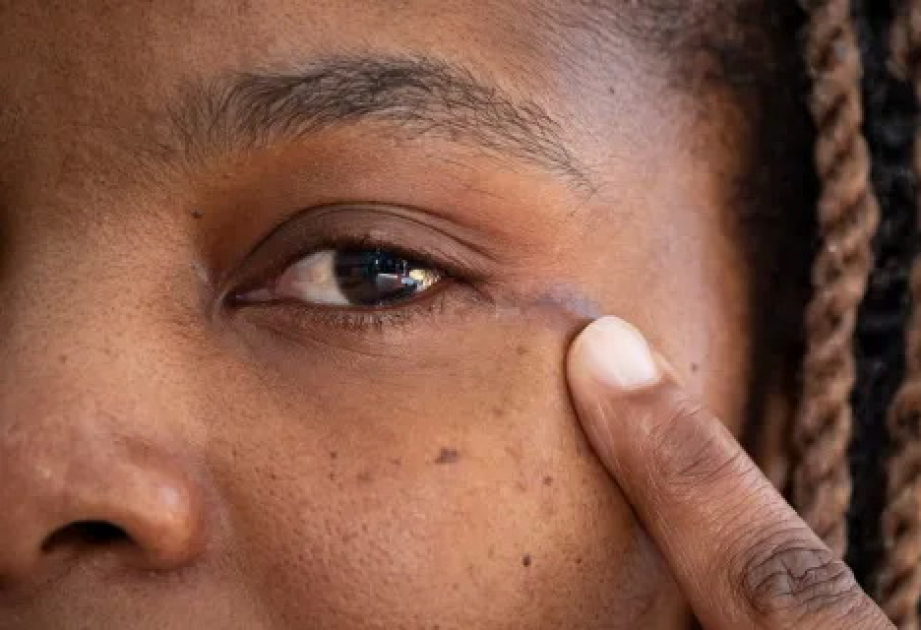 Tibbdə ilk: Böyük Britaniyada göz yuvasından şiş çıxarılıb