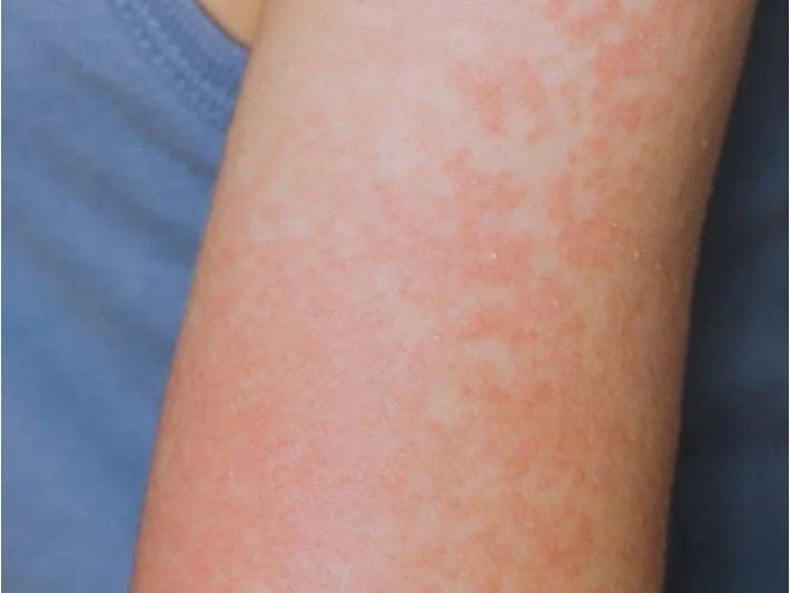 Qızılcaya yoluxma halları artır: Texasda 48 hadisə aşkarlanıb