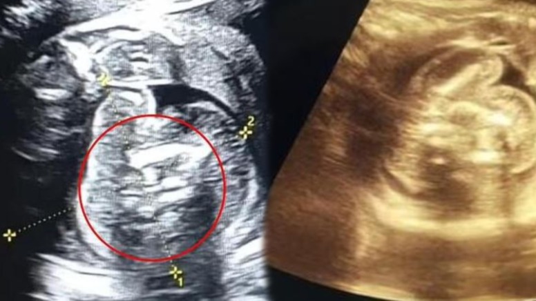 Hindistanda qeyri-adi olay: Yeni doğulan körpədən 2 döl çıxdı