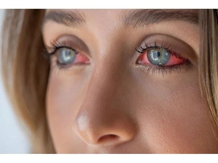 53 yaşlı qadın qəfildən kor oldu: 20 ildir kontakt linzalardan istifadə edirdi