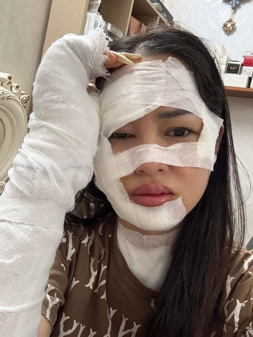 Doğum günündə faciə ilə üzləşdi - Tort şamları əlində partladı