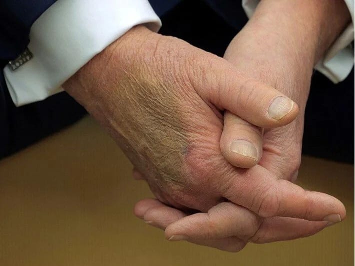 Trampın əlləri gündəmdədir: Sosial mediada göyərmə müzakirəsi