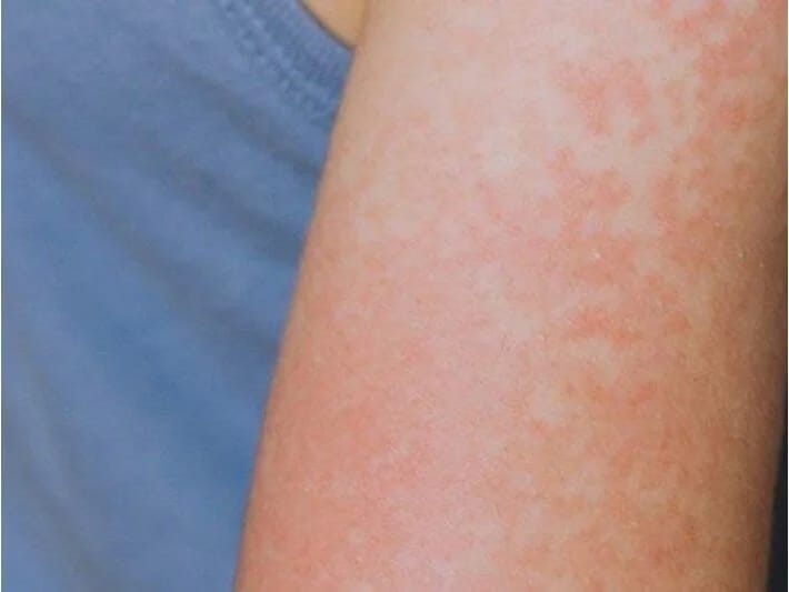 Peyvənd olunmamış uşaq qızılcadan öldü