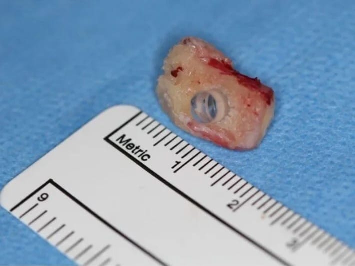 Dişdən alınan parça gözə yapışdırıldı və görmə əldə edildi