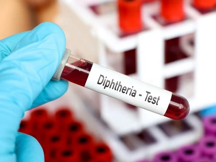 Nigeriyada difteriya epidemiyası: 2022-ci ilin mayından bəri 1319 nəfər ölüb