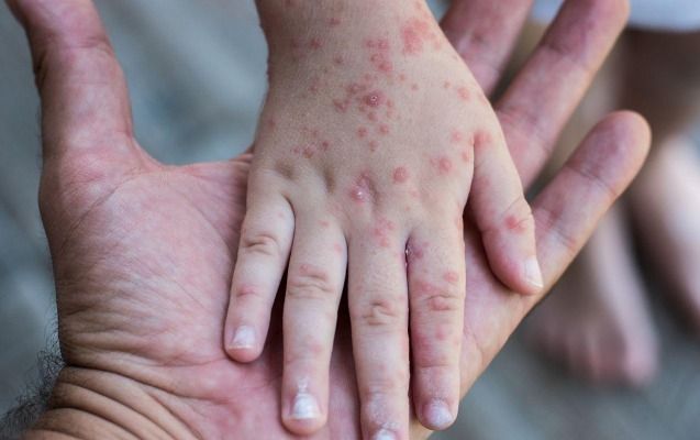 Azərbaycanda suçiçəyi və qızılcaya yoluxma ilə bağlı son vəziyyət AÇIQLANDI