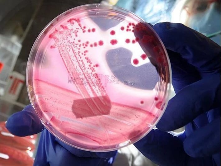 Prostat xərçəngində yeni diaqnoz tüpürcək vasitəsilə aşkar edilir