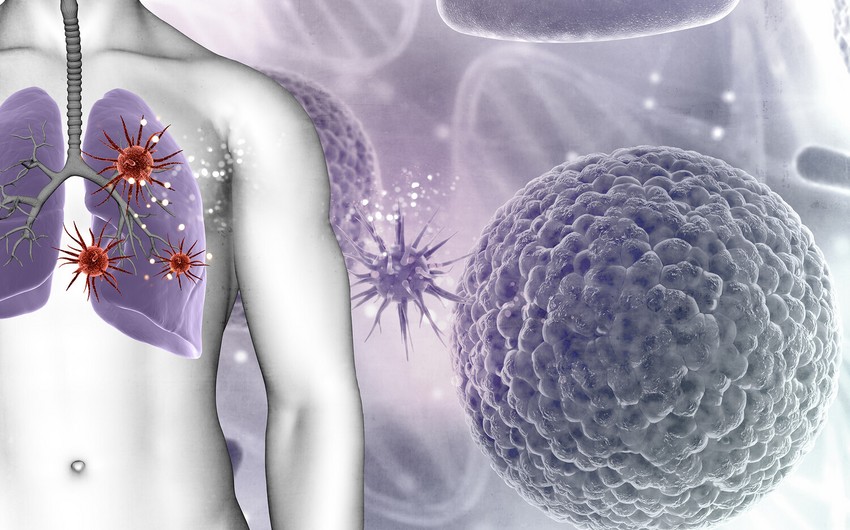 Süni intellekt ağciyər xərçəngini həkimlərdən dörd ay əvvəl aşkarlaya bilib