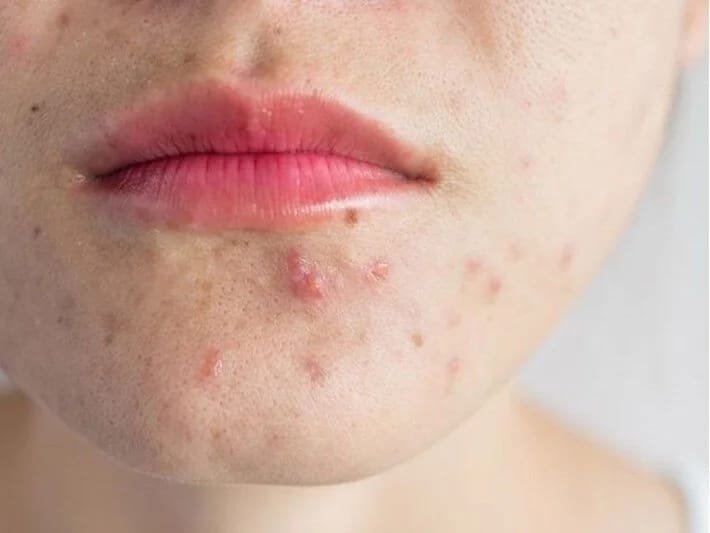 Sızanaqlara qarşı peyvənd hazırlanır