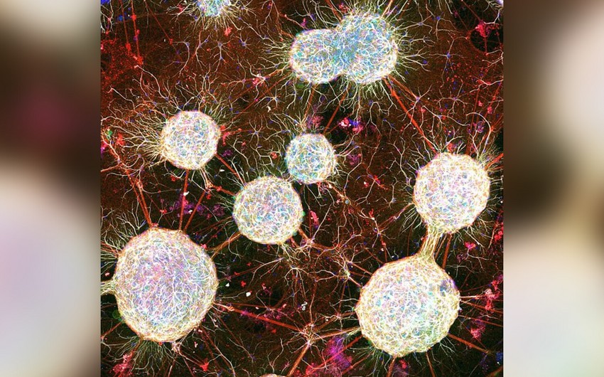 Şizofreniya xəstələrinin beyinləri sağlam insanlara nisbətən daha tez qocalır