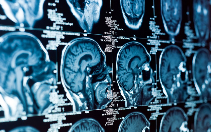 Aqressiv beyin xərçənginin müalicəsində irəliləyiş əldə olunub