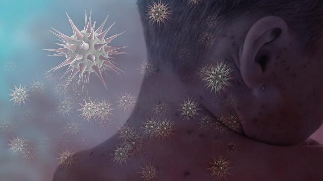 Qızılca Amerikada yayılır: Meksika və Kanadada ölümlər çoxalır 