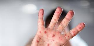 Monqolustanda qızılcaya yoluxan vətəndaşların sayı 7 mini ötüb