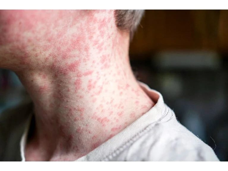 Dünyanın ən yoluxucu xəstəliyi: İzdihamdan çəkinin xəbərdarlığı