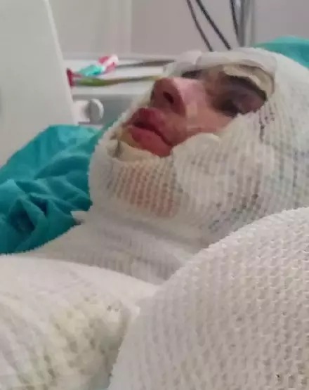 Mirasa görə 16 yaşlı qardaşı oğlunu yandırdı - FOTO