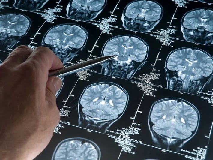 Psixopatların beyni digər insanlardan fərqlidir