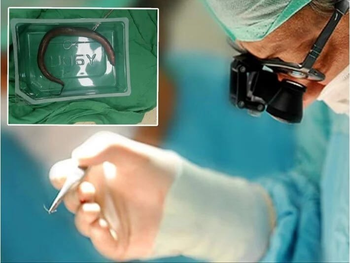 Qarın ağrısı ilə xəstəxanaya müraciət etdi, mədəsində diri ilan balığı tapıldı