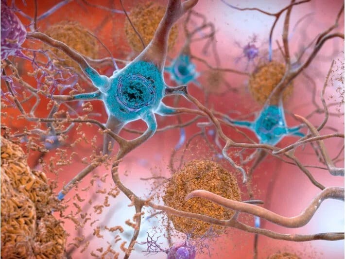 Alzheimerin müalicəsi üçün yeni ümid: İki xərçəng dərmanı bir həll təklif edə bilər