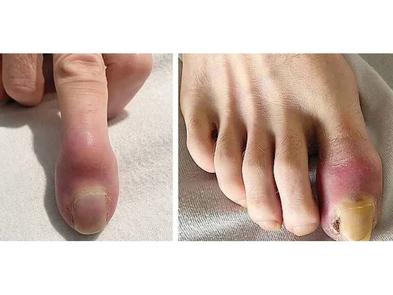 Ağciyər xərçəngi barmaqlarını şişirdib