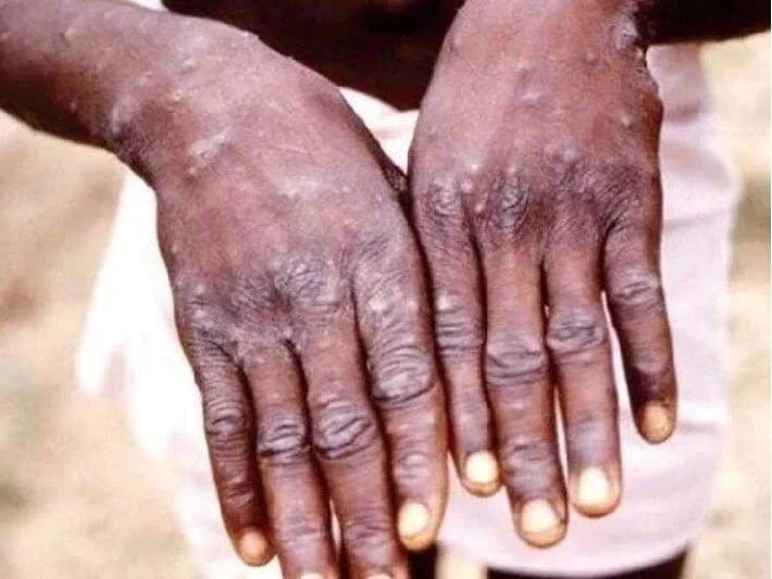 Qanada M çiçəyi virusu yayılır