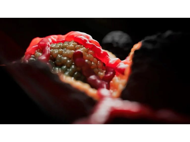 Mütəxəssislər bağırsaq xərçəngi riskini artıran əsas səbəbini dedilər