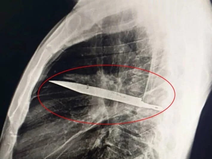 Ağrıdan şikayət edərək xəstəxanaya getdi, sinəsindən bıçaq tapıldı