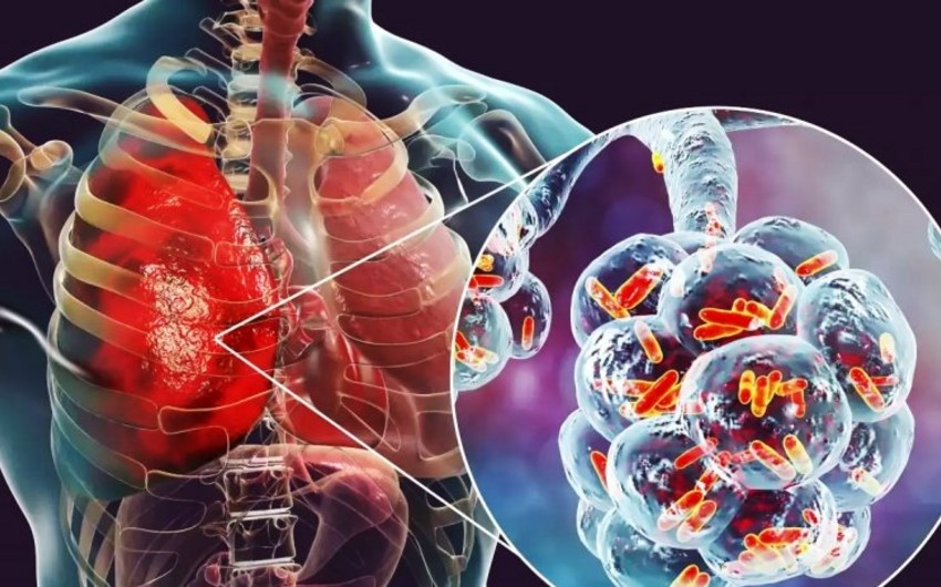 Ötən il Azərbaycanda pnevmoniyaya yoluxan 400-dən çox şəxs ölüb