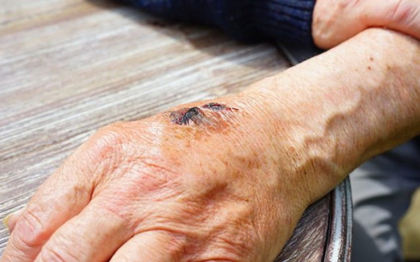 Ötən il Azərbaycanda qarayaraya yoluxanların sayı artıb