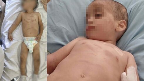 Döyülən azyaşlının vəziyyəti hələ də ağırdır