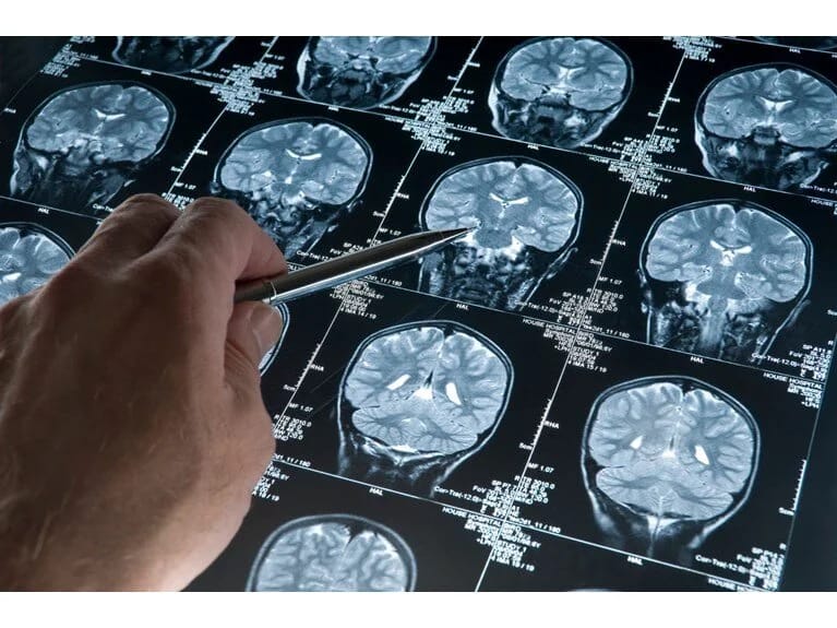 Alzheimer halları niyə artıb?